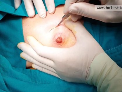 Фиброаденом дојке, приказ операције